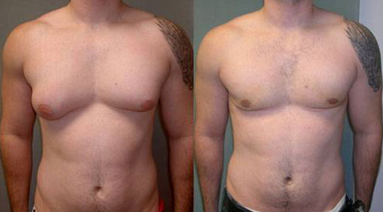 Gynecomastie Tunisie