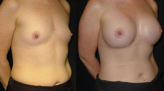 lipofilling seins tunisie