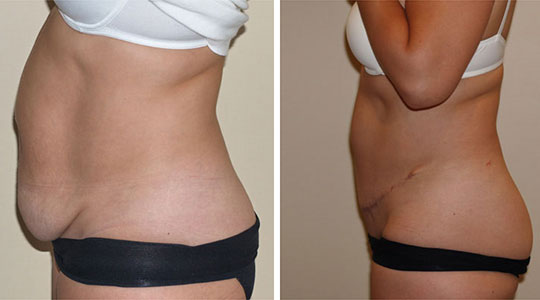 abdominoplastie Tunisie