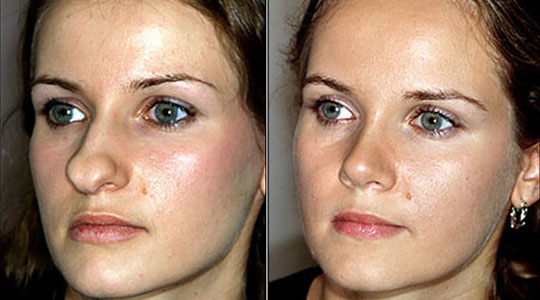 rhinoplastie tunisie