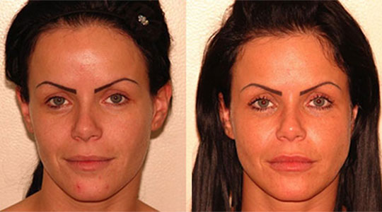 lipofilling visage Tunisie